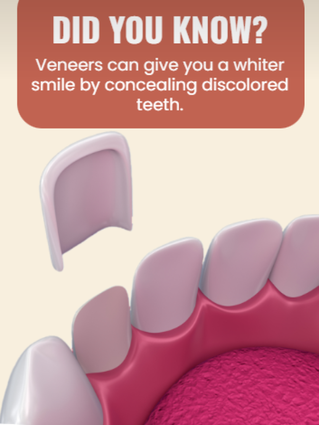 Did you know? Veneers