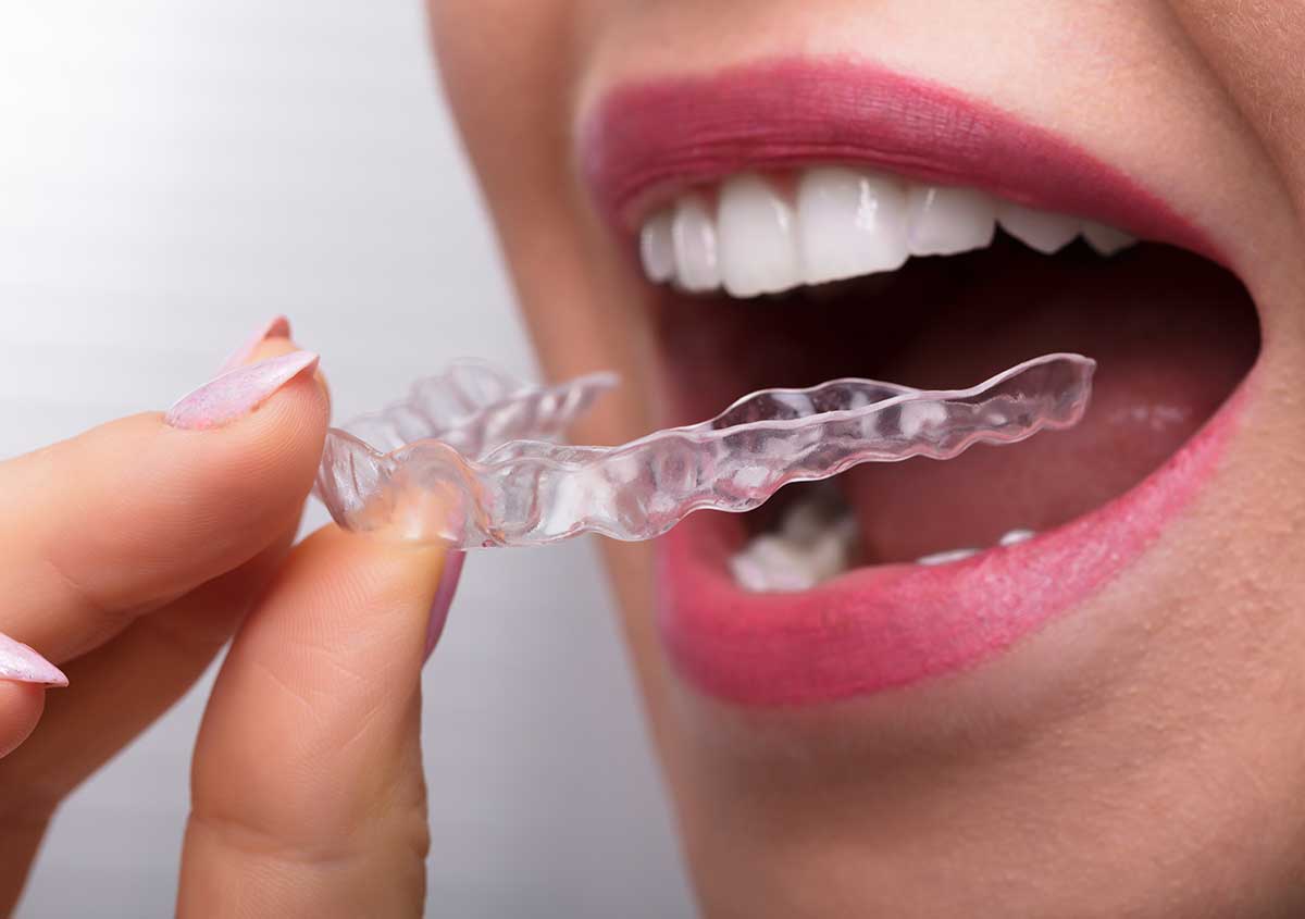 Dental Guards For Bruxism in Solana Beach CA Area