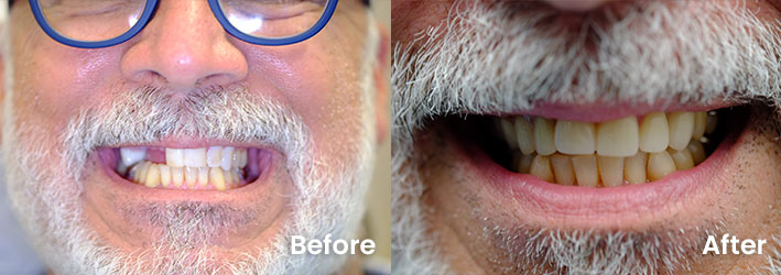 [practice_name] before and after dental implant 2