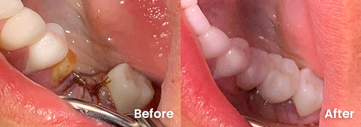 [practice_name] before and after dental implant 3