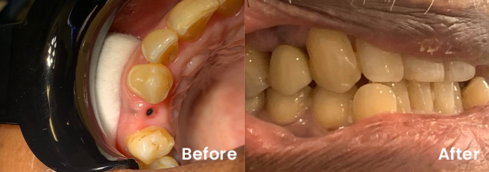 [practice_name] Before and After dental Implant 4