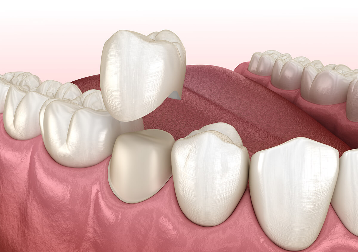 Dental Crown Procedure in Del Mar California Area