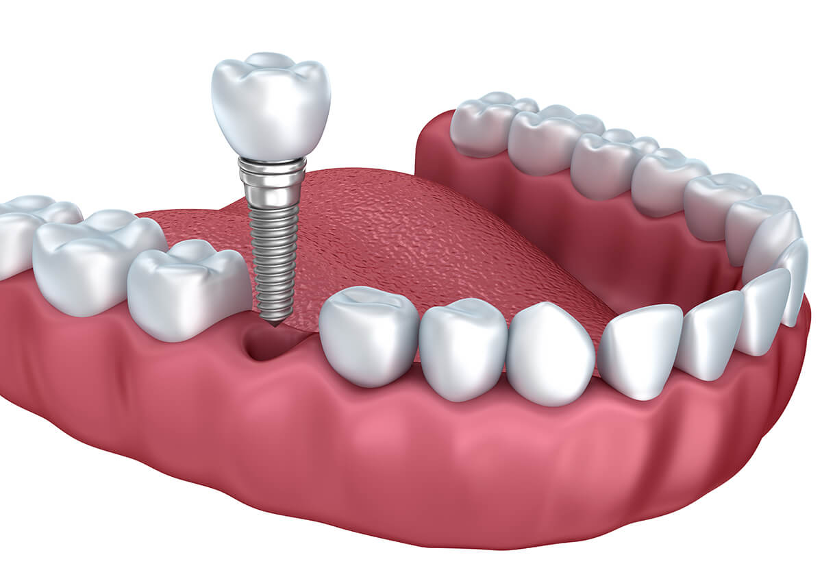 Dental Implant Procedure in Del Mar CA Area