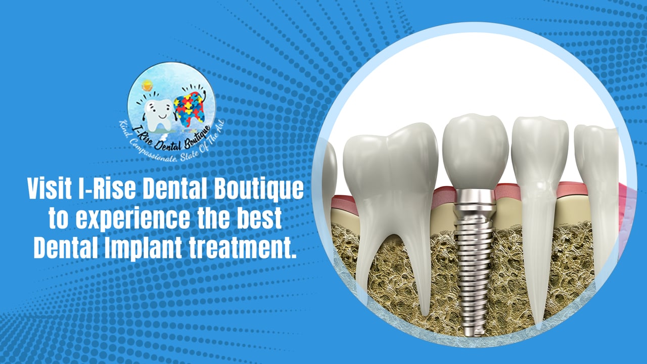 Visit I-Rise Dental Boutique to experience the best Dental Implant treatment