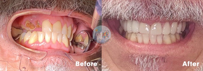 Dental Implants - Before and After Results 5