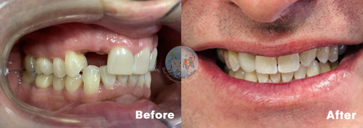 Dental Implants - Before and After Results 6