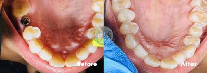 Dental Implants - Before and After Results 7